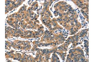 The image on the left is immunohistochemistry of paraffin-embedded Human breast cancer tissue using ABIN7189781(ALOX15 Antibody) at dilution 1/60, on the right is treated with synthetic peptide. (ALOX15 抗体)