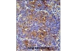 MCAF2 Antibody (Center) (ABIN654466 and ABIN2844199) immunohistochemistry analysis in formalin fixed and paraffin embedded human lung carcinoma followed by peroxidase conjugation of the secondary antibody and DAB staining. (ATF7IP2 抗体  (AA 318-347))
