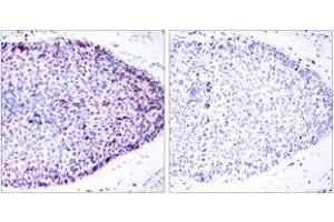 Immunohistochemistry analysis of paraffin-embedded human breast carcinoma tissue, using ATF2 (Ab-62 or 44) Antibody. (ATF2 抗体  (AA 29-78))