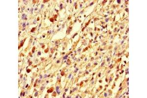 Immunohistochemistry of paraffin-embedded human melanoma using ABIN7153773 at dilution of 1:100 (GMIP 抗体  (AA 719-858))