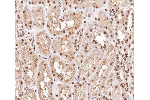 ABIN6267454 at 1/200 staining human kidney carcinoma tissue sections by IHC-P. (MKP-1/2 抗体  (pSer296, pSer318))