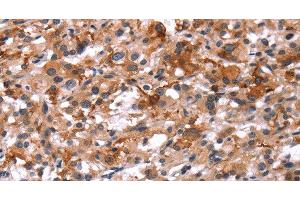 Immunohistochemistry of paraffin-embedded Human thyroid cancer using Glucagon Receptor Polyclonal Antibody at dilution of 1:40 (Glucagon Receptor 抗体)