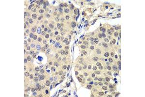 Immunohistochemistry of paraffin-embedded human lung cancer using CCNC antibody. (Cyclin C 抗体  (AA 1-283))