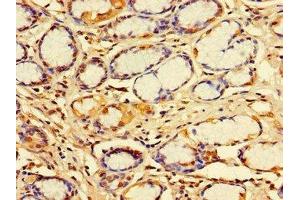 Immunohistochemistry of paraffin-embedded human gastric cancer using ABIN7156344 at dilution of 1:100 (IDE 抗体  (AA 501-800))