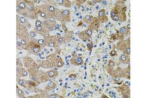 Immunohistochemistry of paraffin-embedded Human liver damage using TGFA Polyclonal Antibody (TGFA 抗体)