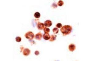 Imunohistochemical analysis of human alveolar macrophages, using MSR1 monoclonal antibody, clone SRA-C6  . (Macrophage Scavenger Receptor 1 抗体)