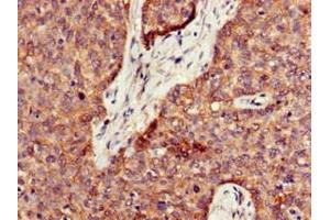 Immunohistochemistry of paraffin-embedded human ovarian cancer using ABIN7162531 at dilution of 1:100 (PPT1 抗体  (AA 100-258))