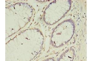 Immunohistochemistry of paraffin-embedded human colon cancer using ABIN7175400 at dilution of 1:100 (Vasohibin 2 抗体  (AA 1-156))