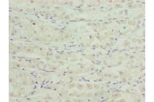 Immunohistochemistry of paraffin-embedded human gastric cancer using ABIN7171874 at dilution of 1:100 (TSPAN33 抗体  (AA 118-235))
