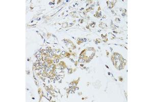 Immunohistochemistry of paraffin-embedded human gastric cancer using MAD2L2 antibody (ABIN6003593) at dilution of 1/100 (40x lens). (MAD2L2 抗体)