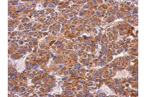 IHC-P Image Immunohistochemical analysis of paraffin-embedded human hepatoma, using Integrin alpha 9, antibody at 1:500 dilution. (ITGA9 抗体  (N-Term))