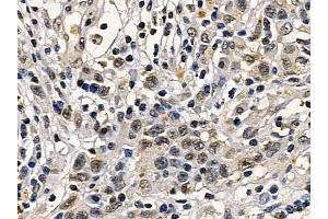 Retinoblastoma Mouse Monoclonal Antibody at 1/100 staining human gastric cancer by IHC-P. (Retinoblastoma Protein (Rb) 抗体  (Internal Region))