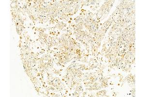 ABIN6258146 and ABIN6273919 at 1/100 staining Human liver cancer by IHC-P.
