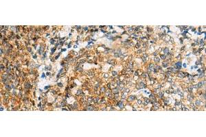 Immunohistochemistry of paraffin-embedded Human cervical cancer tissue using TUFT1 Polyclonal Antibody at dilution of 1:120(x200) (TUFT1 抗体)