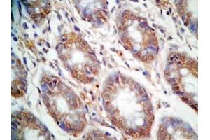 Human colon cancer tissue was stained by Rabbit Anti-CCK (26-33)  (Human,Rat) Antibody (Cholecystokinin 抗体  (non-sulfated))