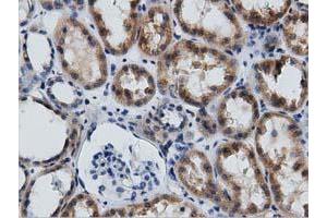 Immunohistochemical staining of paraffin-embedded Adenocarcinoma of Human endometrium tissue using anti-GAS7 mouse monoclonal antibody. (GAS7 抗体)