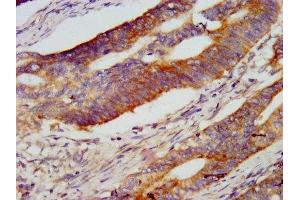 IHC image of ABIN7151176 diluted at 1:800 and staining in paraffin-embedded human colon cancer performed on a Leica BondTM system. (RNF213 抗体  (AA 202-350))