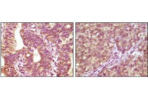 Immunohistochemical analysis of paraffin-embedded human bladder carcinoma tissue(left) and lung carcinoma tissue (right) showing cytoplasmic localization using BRAF mouse mAb with DAB staining. (BRAF 抗体)