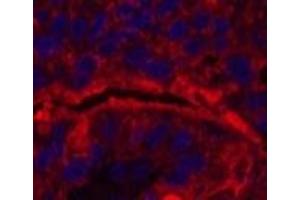 Immunofluorescence analysis of Human liver cancer tissue using CD15 Monoclonal Antibody at dilution of 1:200. (CD15 抗体)