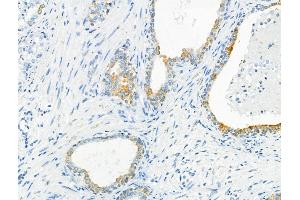 ABIN6262787 and ABIN6266575 at 1/100 staining human ovarian cancer by IHC-P. (Cytokeratin 7 抗体  (C-Term))