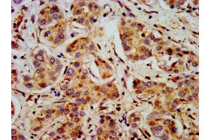 IHC image of ABIN7169467 diluted at 1:400 and staining in paraffin-embedded human liver cancer performed on a Leica BondTM system. (SHANK2 抗体  (AA 728-822))