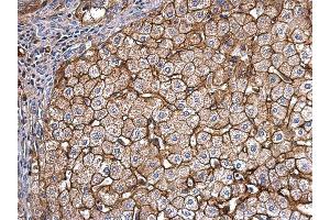 IHC-P Image Apolipoprotein E antibody detects Apolipoprotein E protein at secreted on human hepatoma by immunohistochemical analysis. (APOE 抗体  (N-Term))