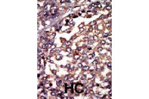 Formalin-fixed and paraffin-embedded human hepatocellular carcinoma tissue reacted with PRKAR1A polyclonal antibody  , which was peroxidase-conjugated to the secondary antibody, followed by AEC staining. (PRKAR1A 抗体  (N-Term))