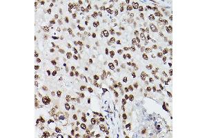 Immunohistochemistry of paraffin-embedded human breast cancer using PSME3 Rabbit pAb (ABIN6135015, ABIN6146357, ABIN6146358 and ABIN6216428) at dilution of 1:100 (40x lens). (PSME3 抗体  (C-Term))