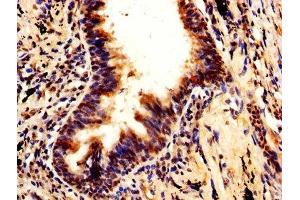 IHC image of ABIN7168493 diluted at 1:600 and staining in paraffin-embedded human lung cancer performed on a Leica BondTM system. (RUVBL1 抗体  (AA 101-400))