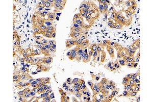 Immunohistochemistry analysis of paraffin-embedded human liver cancer using CD107b Polyclonal Antibody at dilution of 1:300. (LAMP2 抗体)