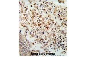 Formalin-fixed and paraffin-embedded human lung carcinoma reacted with FPRL2 Antibody (Center), which was peroxidase-conjugated to the secondary antibody, followed by DAB staining. (FPR3 抗体  (AA 307-333))
