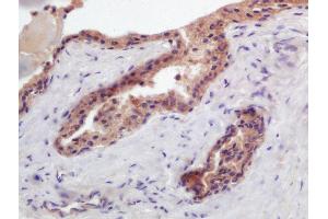 Formalin-fixed and paraffin embedded human prostate carcinoma labeled with Anti-PTGFR Polyclonal Antibody, Unconjugated (ABIN2178742) at 1:200 followed by conjugation to the secondary antibody and DAB staining (PTGFR 抗体  (AA 121-220))