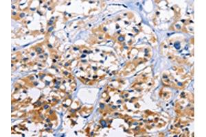 The image on the left is immunohistochemistry of paraffin-embedded Human thyroid cancer tissue using ABIN7128760(CAPZA3 Antibody) at dilution 1/70, on the right is treated with fusion protein. (CAPZA3 抗体)