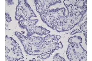 IHC staining of formalin fixed and paraffin embedded thyroid carcinoma tissue with recombinant BRAF V600E antibody. (Recombinant BRAF 抗体  (Val600Glu-Mutant))