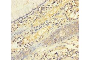 Immunohistochemistry of paraffin-embedded human colon cancer using ABIN7173813 at dilution of 1:100 (FASL 抗体  (AA 103-281))
