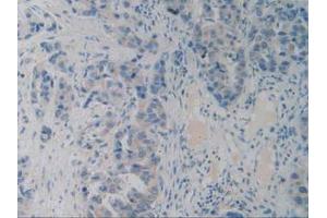 IHC-P analysis of Human Breast Cancer Tissue, with DAB staining. (PACAP 抗体  (AA 17-176))