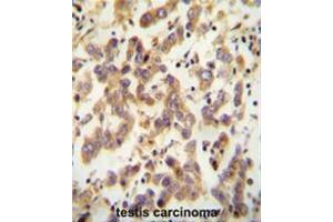 CT173 antibody (Center) immunohistochemistry analysis in formalin fixed and paraffin embedded human testis carcinoma followed by peroxidase conjugation of the secondary antibody and DAB staining. (C20ORF173 抗体  (Middle Region))