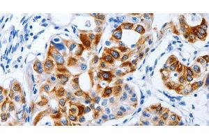 Immunohistochemistry of paraffin-embedded Human lung cancer using BPIFB3 Polyclonal Antibody at dilution of 1:120 (BPIFB3 抗体)