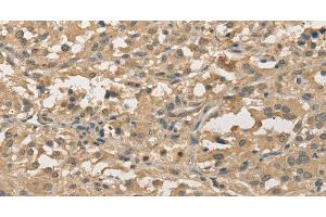 Immunohistochemistry of paraffin-embedded Human thyroid cancer using ALDH8A1 Polyclonal Antibody at dilution of 1:30 (ALDH8A1 抗体)