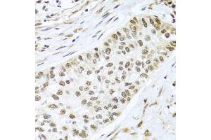 Immunohistochemistry of paraffin-embedded human lung cancer using PGR antibody. (Progesterone Receptor 抗体)