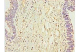 Immunohistochemistry of paraffin-embedded human ovarian cancer using ABIN7146349 at dilution of 1:100 (CALCOCO2 抗体  (AA 137-446))