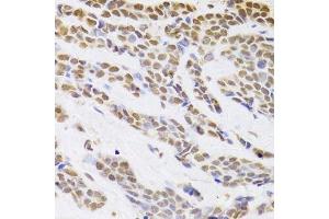 Immunohistochemistry of paraffin-embedded human breast cancer using HDGF Antibody. (HDGF 抗体  (AA 1-240))