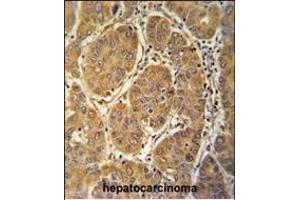 MCEE antibody (C-term) (ABIN653998 and ABIN2843935) immunohistochemistry analysis in formalin fixed and paraffin embedded human hepatocarcinoma followed by peroxidase conjugation of the secondary antibody and DAB staining. (MCEE 抗体  (C-Term))