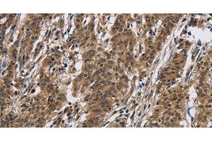 Immunohistochemistry of paraffin-embedded Human gasrtic cancer tissue using IL12RB2 Polyclonal Antibody at dilution 1:40 (IL12RB2 抗体)