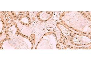 Immunohistochemistry of paraffin-embedded Human thyroid cancer tissue using SETDB1 Polyclonal Antibody at dilution of 1:60(x200) (SETDB1 抗体)