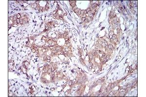 Immunohistochemical analysis of paraffin-embedded cervical cancer tissues using EPCAM mouse mAb with DAB staining. (EpCAM 抗体  (AA 24-265))