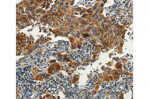 Immunohistochemistry of Human lung cancer using SERPINA9 Polyclonal Antibody at dilution of 1:60 (SERPINA9 抗体)