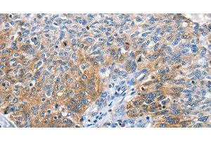 Immunohistochemistry of paraffin-embedded Human ovarian cancer tissue using CGB Polyclonal Antibody at dilution 1:60 (CGB 抗体)
