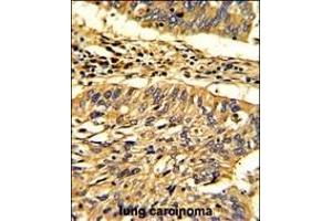 Formalin-fixed and paraffin-embedded human lung carcinoma with Hsp 60 Antibody (N-term), which was peroxidase-conjugated to the secondary antibody, followed by DAB staining. (HSPD1 抗体  (N-Term))
