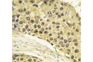 IHC analysis of FFPE human breast carcinoma tissue stained with Cyclin A2 antibody (Cyclin A 抗体  (AA 358-389))